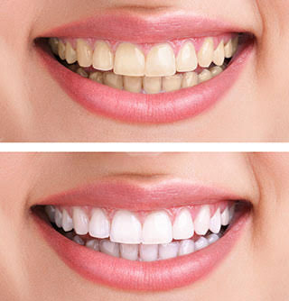 TeethWhitening