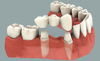 dental-bridges