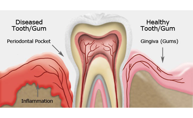 periodonta